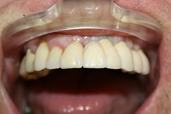 After dental implants